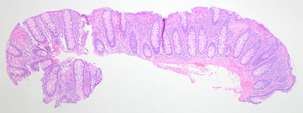 Figure 1: H&E (4x). Crypt architecture is maintained and increased cellularity of the lamina propria.