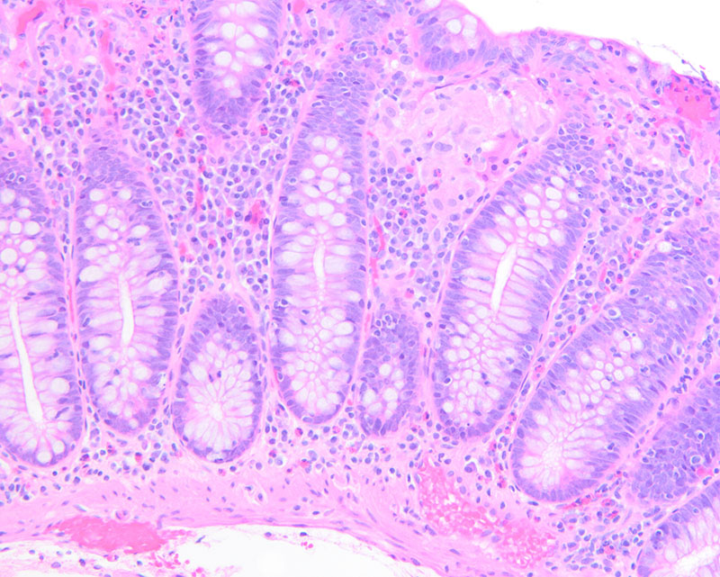 Figure 3: H&E (20x). There are collections of cells with abundant eosinophilic cytoplasm and multiple bland nuclei randomly distributed throughout the lamina propria below the surface epithelium.