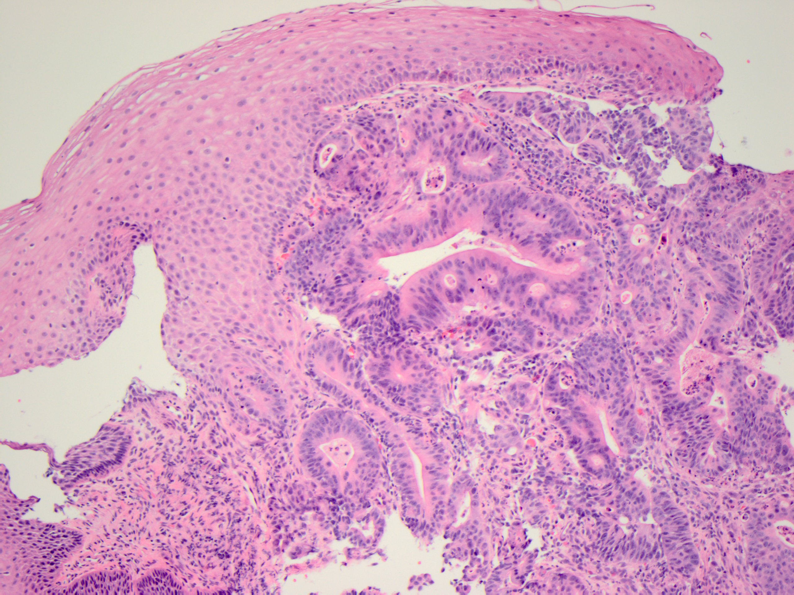Figure 5: Esophageal mass, 100x magnification.