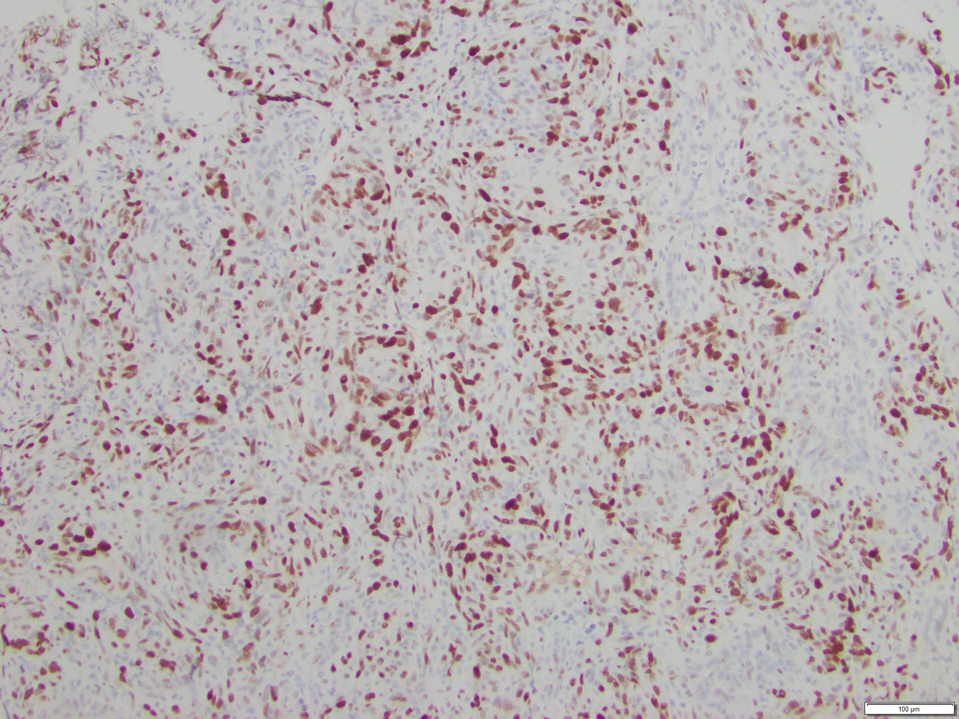Figure 5. Positive c-MYC immunohistochemical staining.