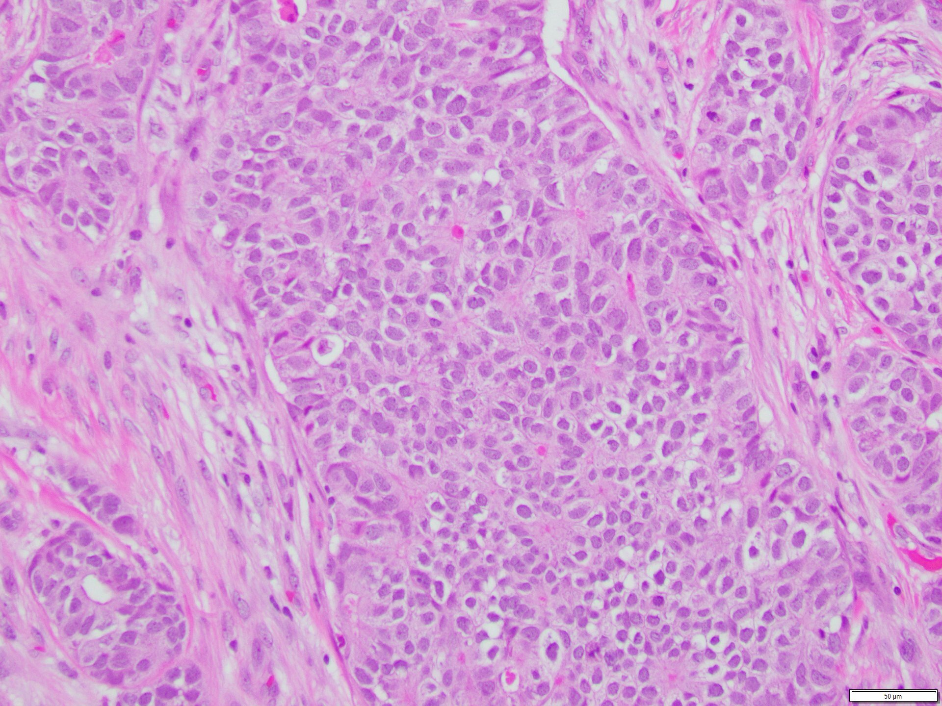 Figure 7. Patient’s prior breast carcinoma. 