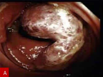Figure A: Colonoscopy findings showing mass-like lesion at the ileocecal valve.