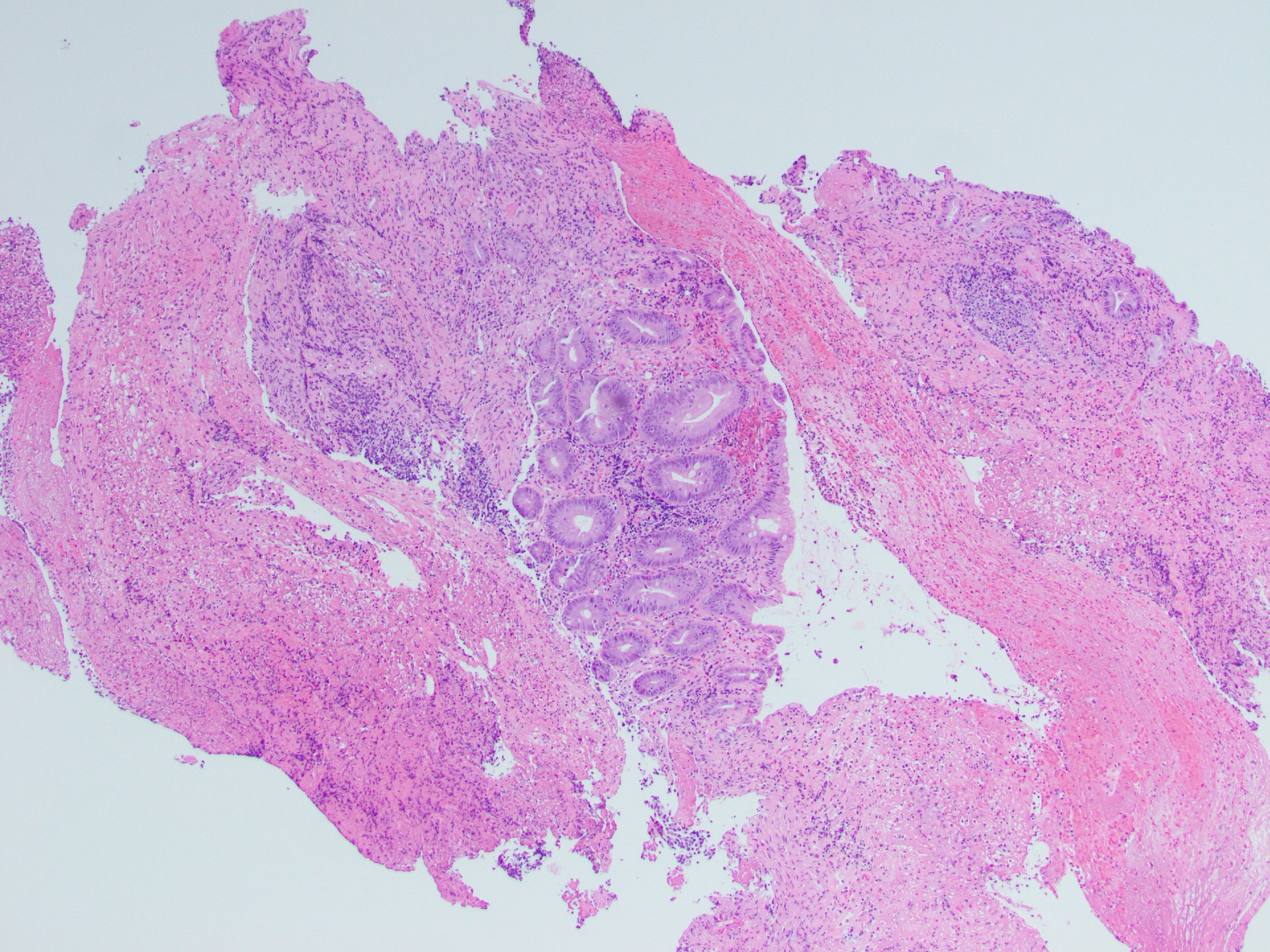 Figure B: H & E stain of colonic biopsy specimen at 10X.