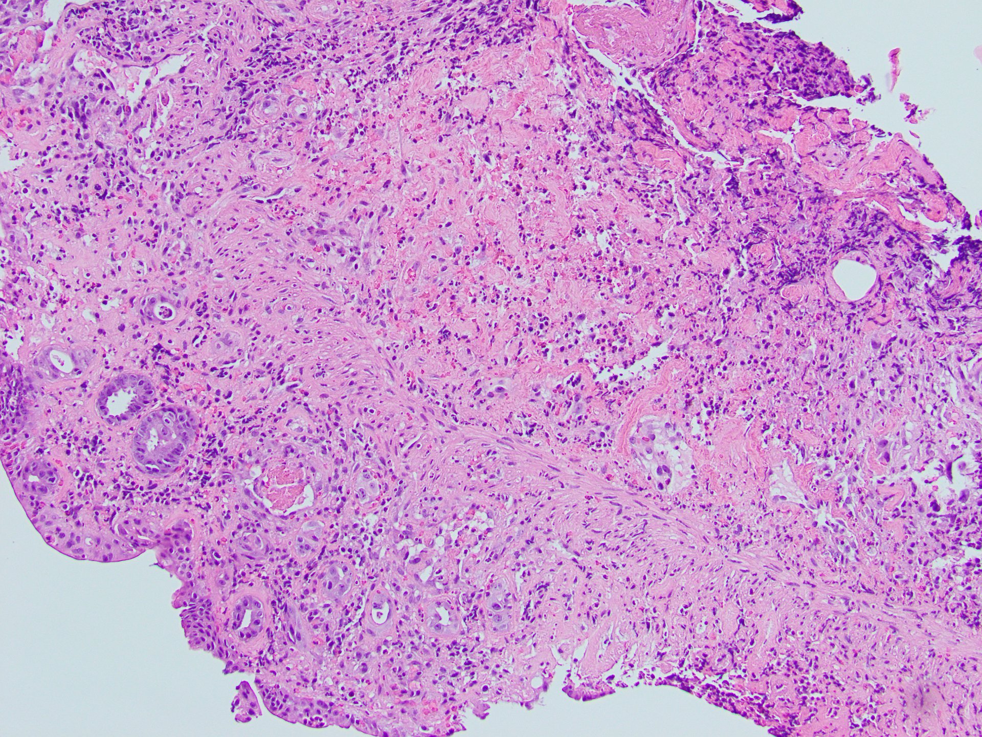 Figure C: H & E stain of colonic biopsy specimen at 20X demonstrating lamina propria hyalinization, crypt atrophy and loss.