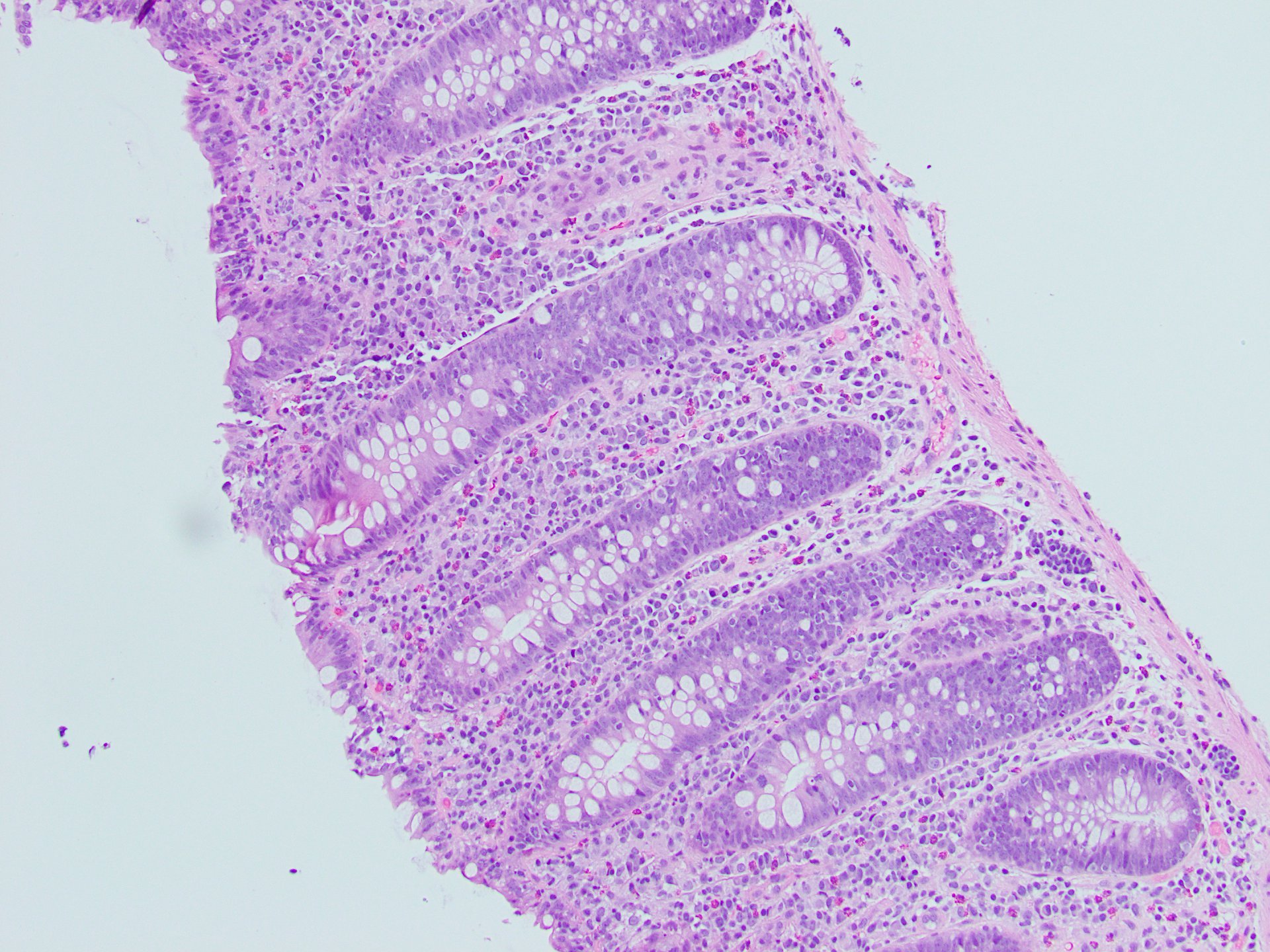 Figure D: H & E stain of colonic biopsy specimen at 20X.