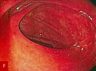 Figure F: Colonoscopy findings following medical management with full resolution of the mass-like lesion.