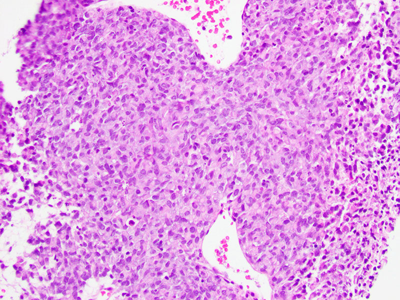 Figure 1: CT-guided biopsy of mass shows malignant cells with eosinophilic cytoplasm and round to ovoid eccentric nuclei.