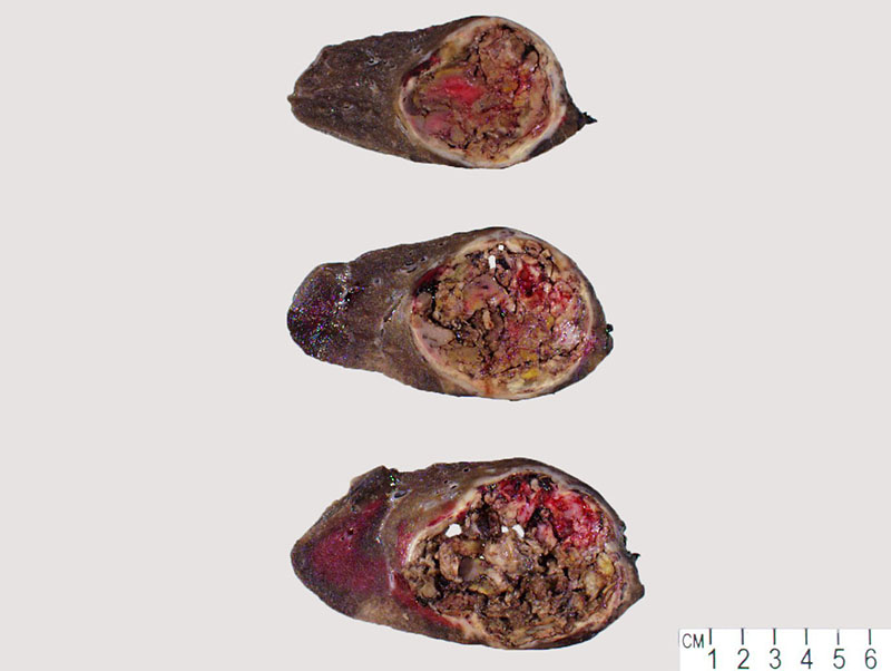 Figure 2: Gross exam of right upper lobe demonstrated an 11.1 x 8.1 x 6.5 cm mass.