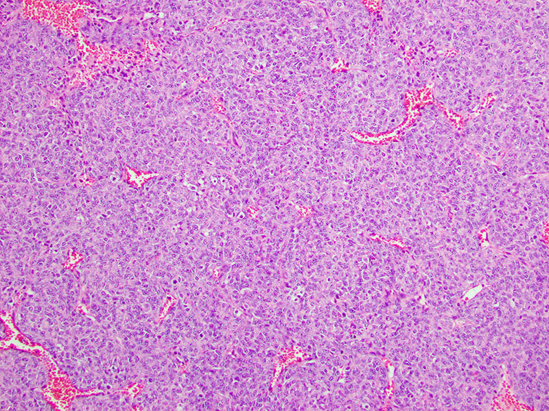Figure 4: Scattered blood vessels shown surrounding epithelioid cells.