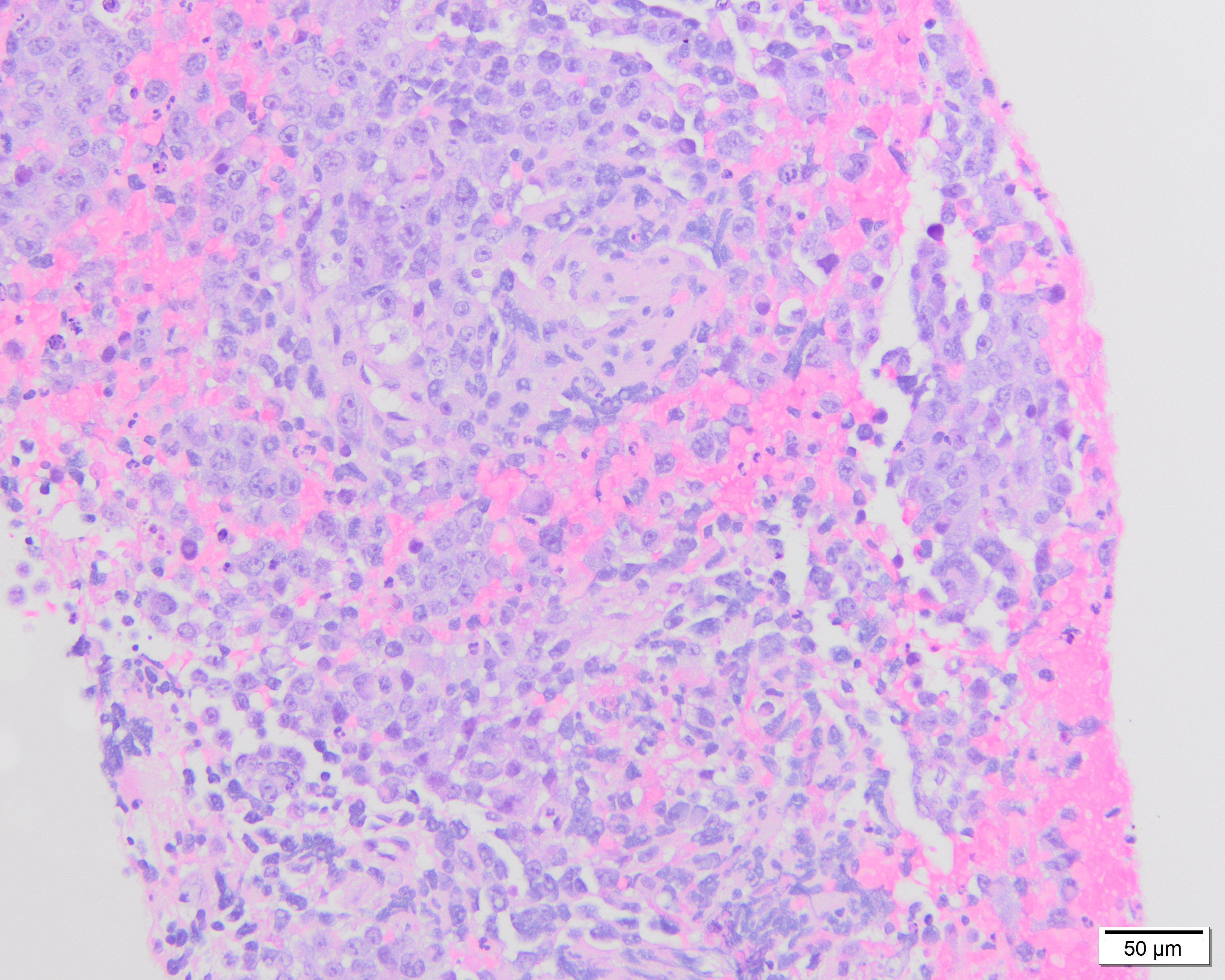 Figure 1: H&E lymph node biopsy 20x magnification