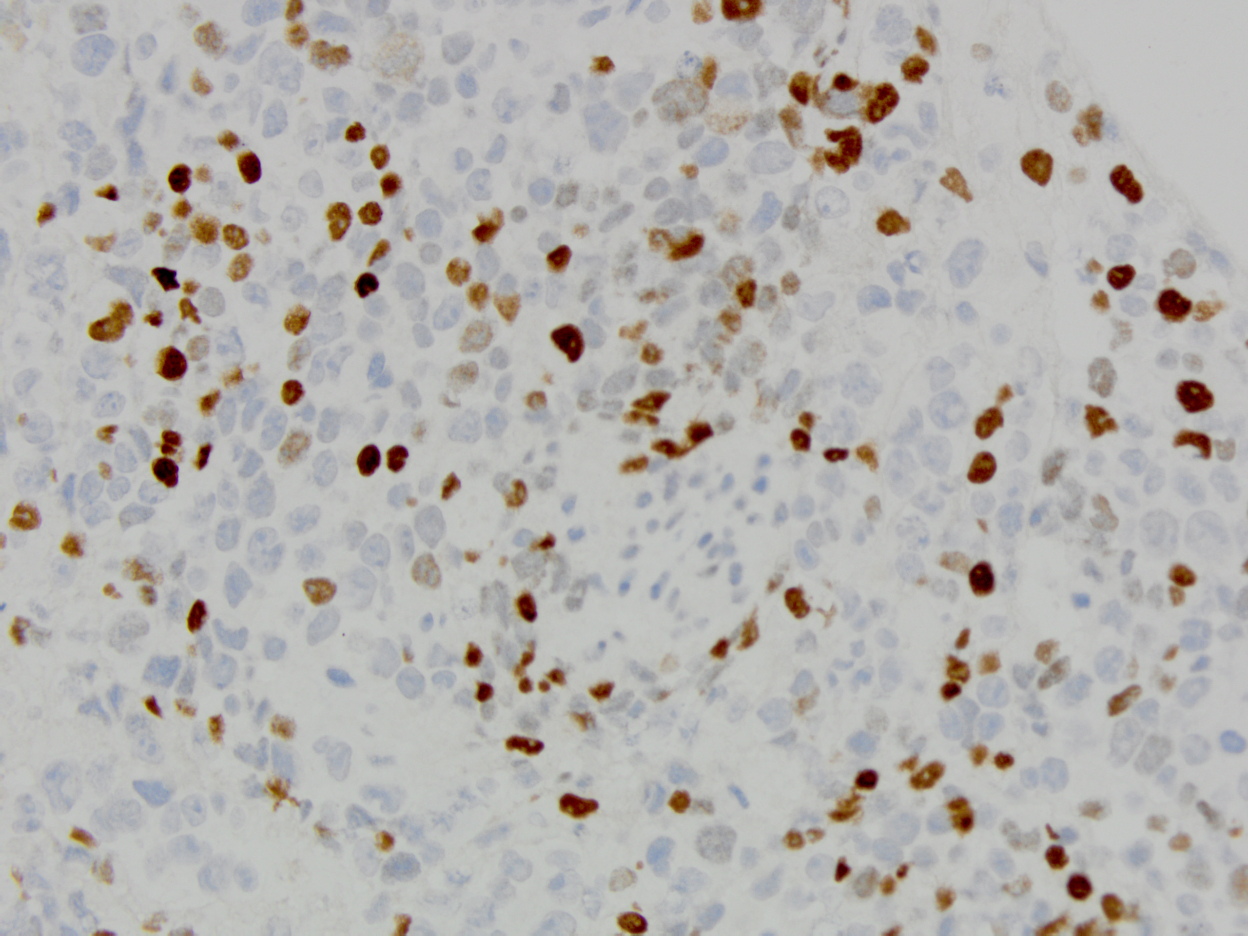 Figure 4: P40 immunohistochemical stain 40x magnification.