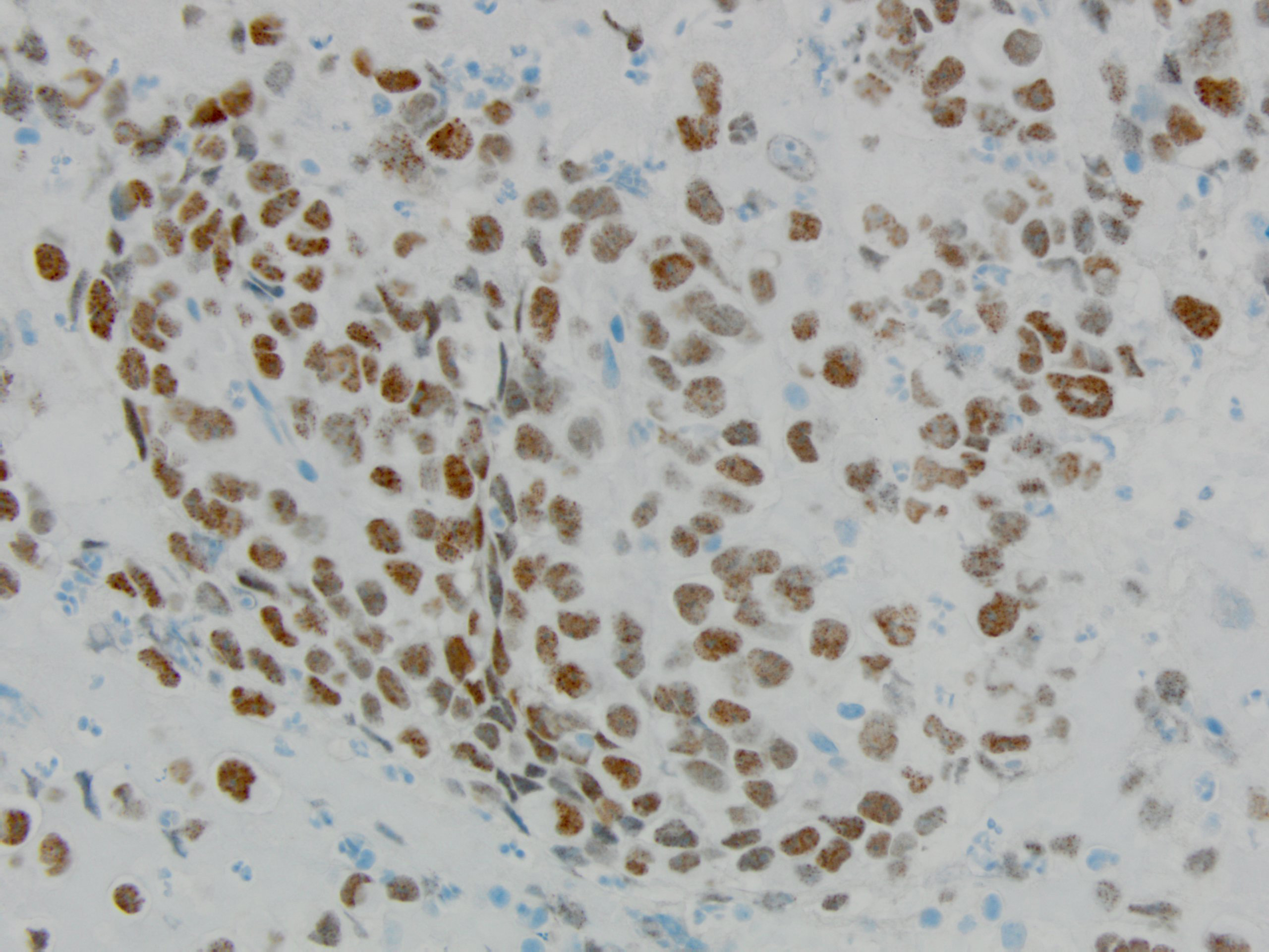 Figure 5: NUT1 immunohistochemical stain 40x magnification.