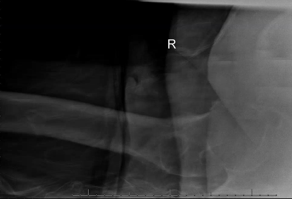 Figure 2: Femoral neck fracture.
