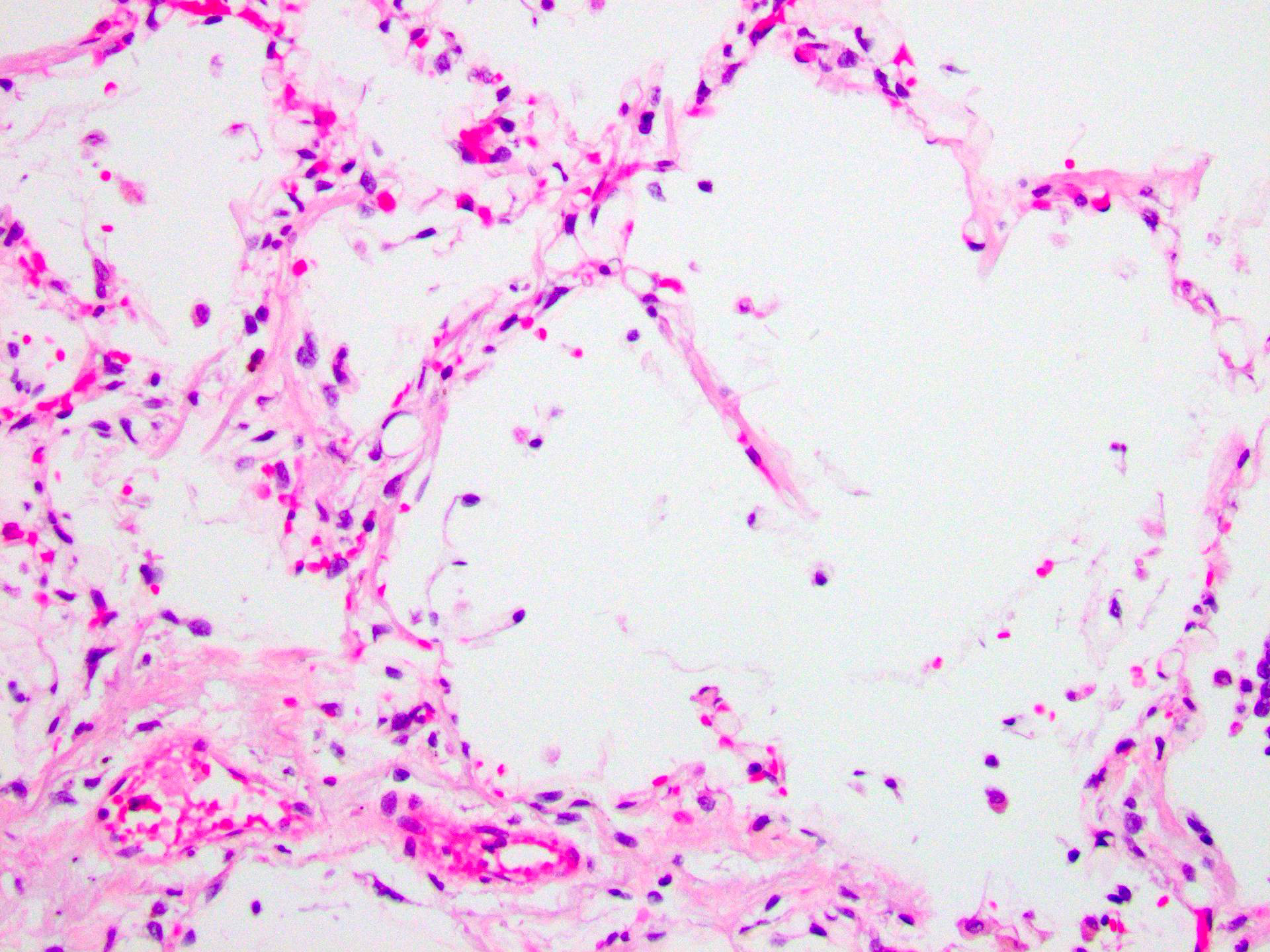 Figure 3: Rounded empty spaces within the intra-alveolar capillaries (H&E, 200x).