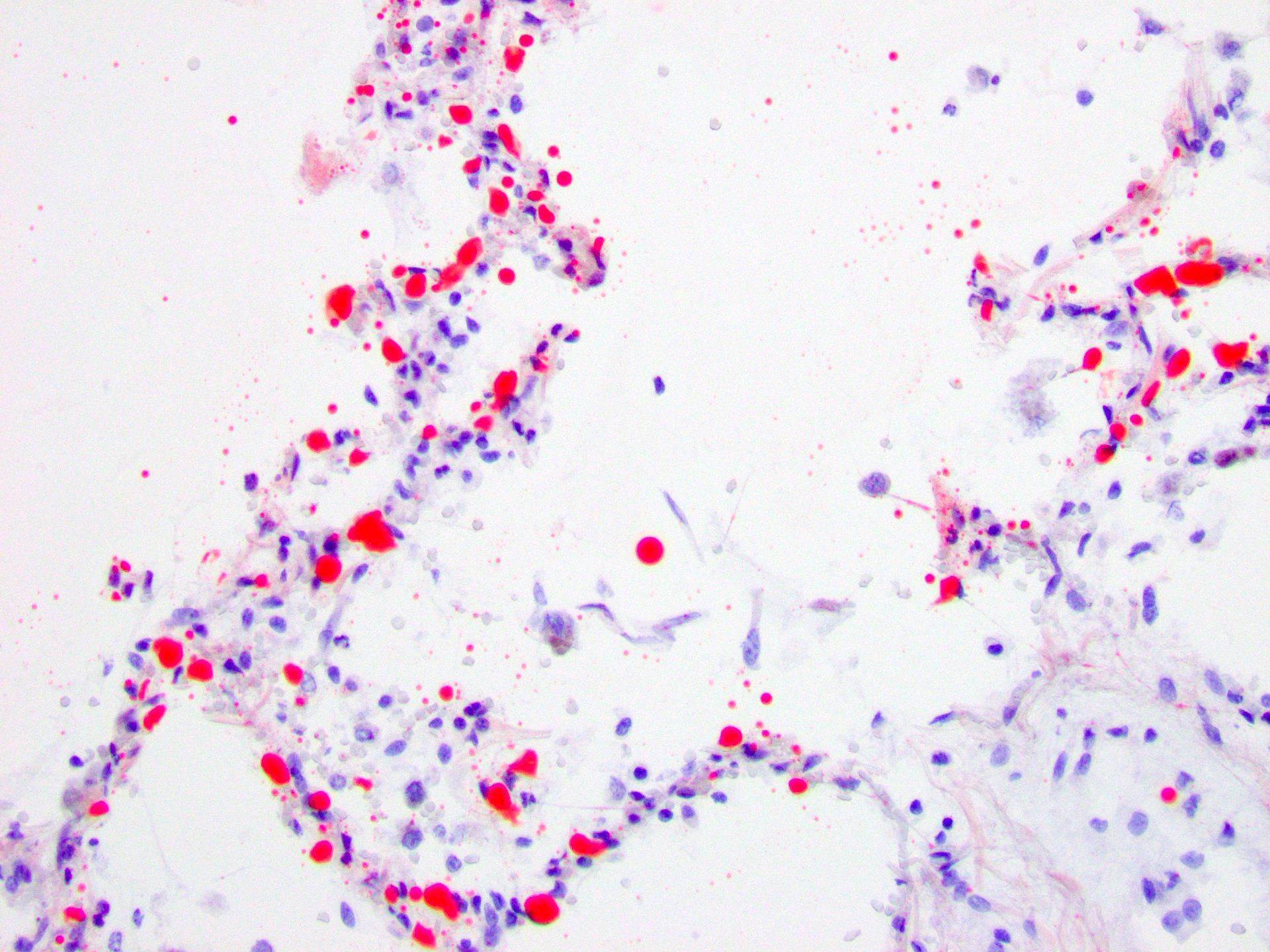 Figure 4: Diffusely positive staining of the globular empty spaces in the intra-alveolar capillaries (Oil Red O, 200x).