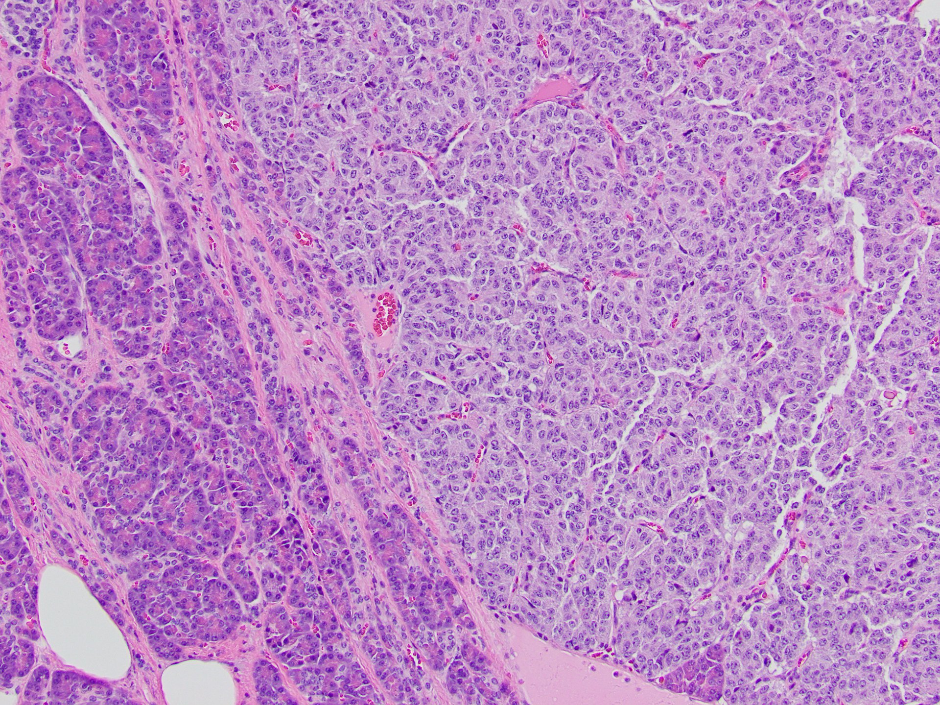Figure 1: PanNET. Nests of tumor cells are separated by delicate vascularized fibrous stroma. Note surrounding uninvolved pancreas on the left of the field. H&E x100.