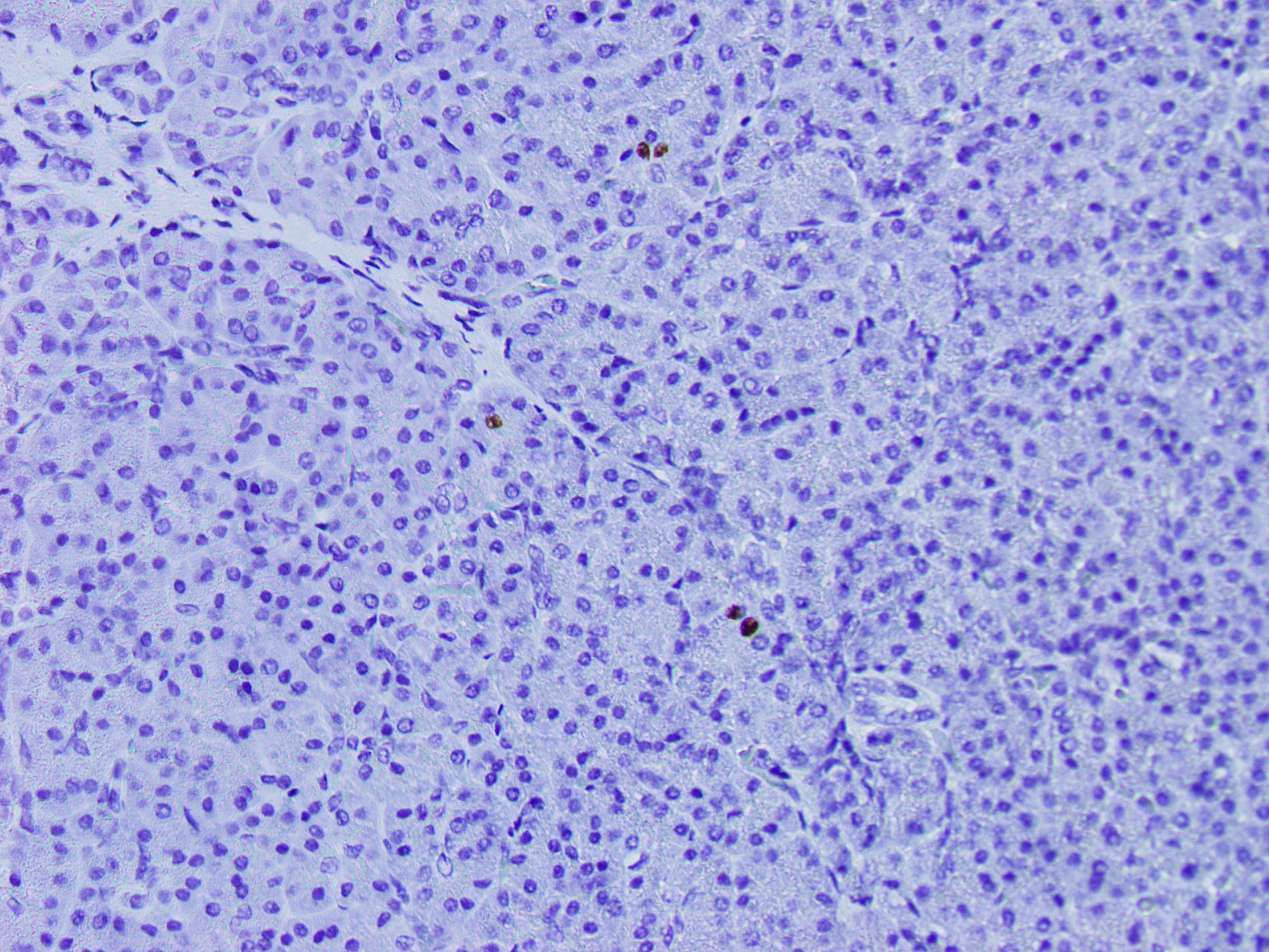 Figure 5: Ki67 stain. There is rare positivity (brown-staining nuclei) for Ki-67.  x200.