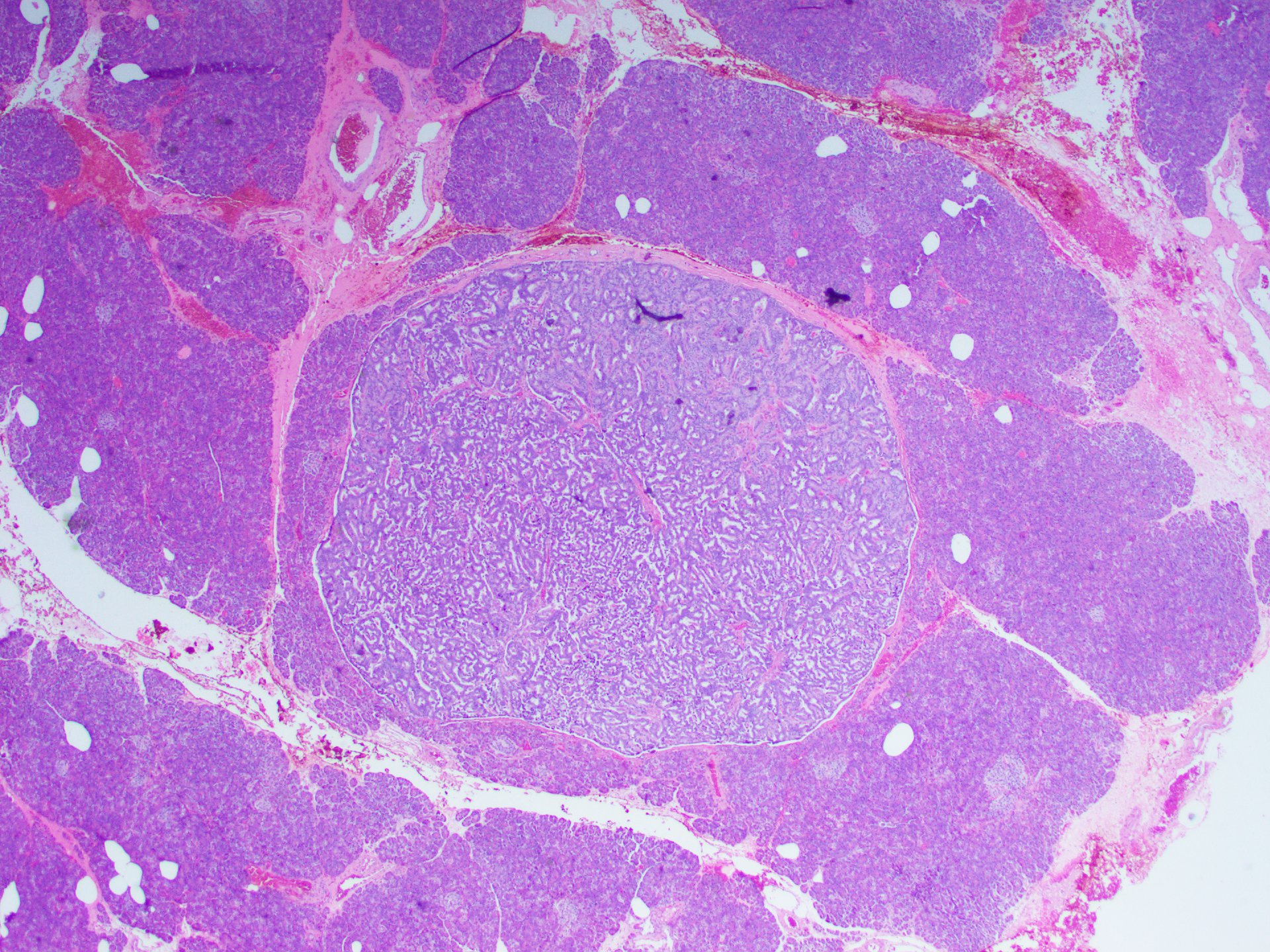Figure 6: A microadenoma. Microadenomas have identical cytomorphology to PanNETs. Note the surrounding uninvolved pancreas. H&E x20.