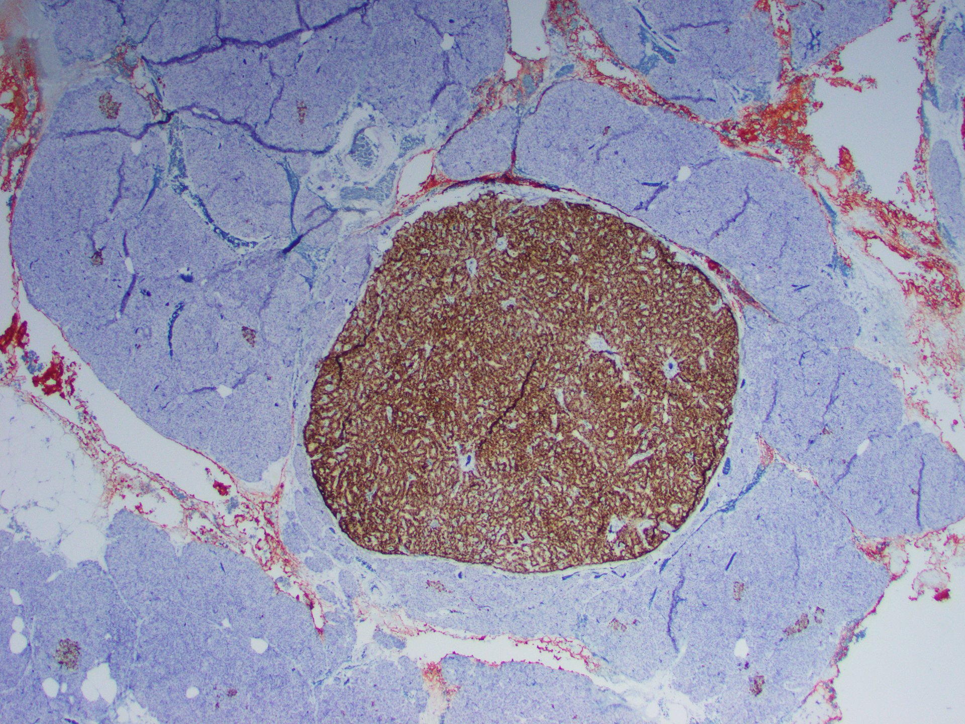 Figure 8: The patient’s microadenoma showed strong positive staining for chromogranin, similar to the PanNET. x20.