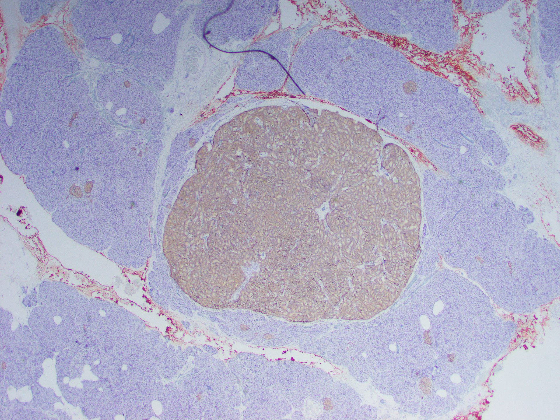Figure 9: The patient’s microadenoma was also positive for synaptophysin. x20.
