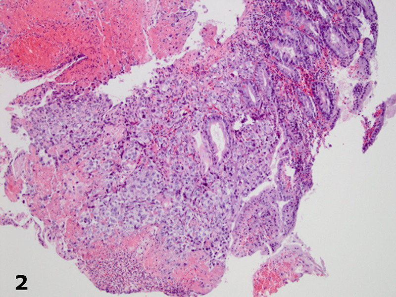 Small bowel mucosa with malignant cells occupying the lamina propria without surface epithelial dysplasia (H&E, original magnification x 100).