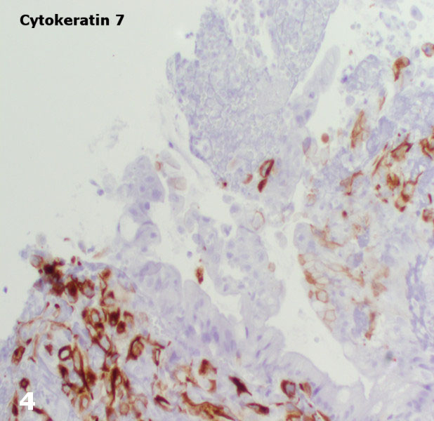 Cytokeratin 7 is positive in the malignant cells (cytokeratin 7 immunohistochemical stain, original magnification x 100).