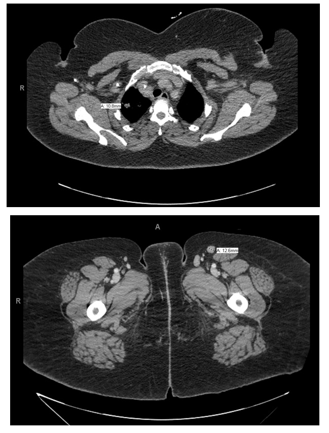 Figure 1: Bilateral axillary, mesenteric, retroperitoneal, and inguinal lymphadenopathy identified on CT.