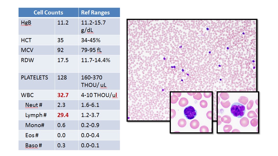Figure 2: Flow cytometry revealed that the lymphocyte population was essentially composed of CD3 positive T cells with a CD4/CD8 ratio of 50:1.