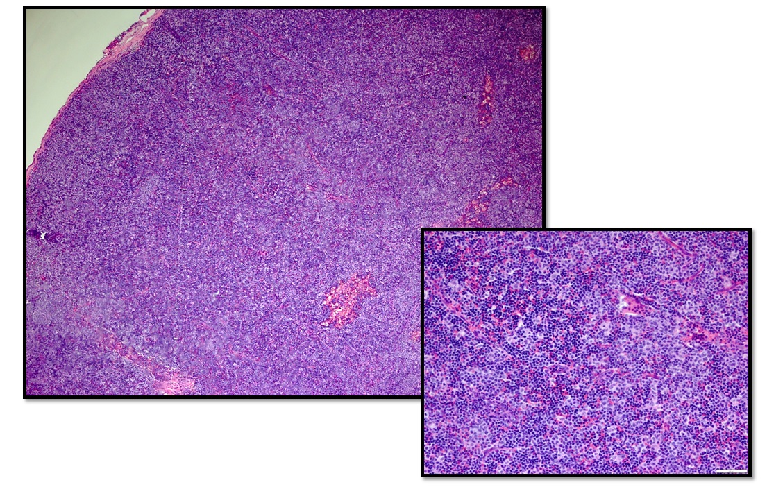 Figure 3: Immunohistochemistry revealed the cells of interest stained positive for CD2, CD3, CD5, and CD25 and were predominantly CD4 positive with scattered CD8 positivity.
