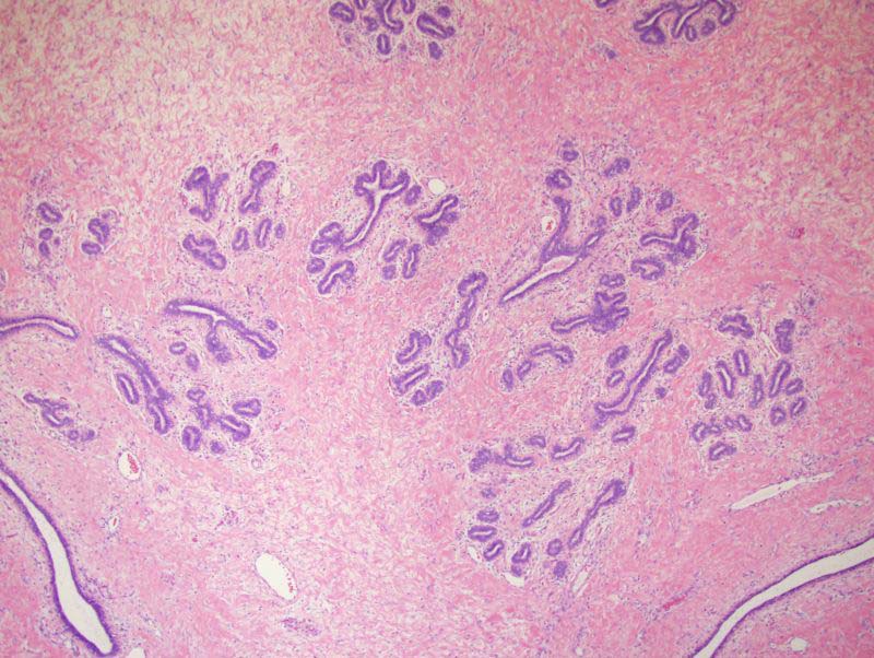 Eosinophilic fibrous tissue surrounding ductal and lobular structures that form intact terminal ductal lobular units. 