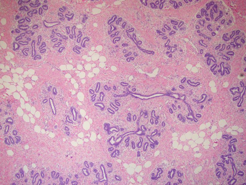 Adipocytes mixed with fibrous stroma and larger ductal structures that have an angular appearance.