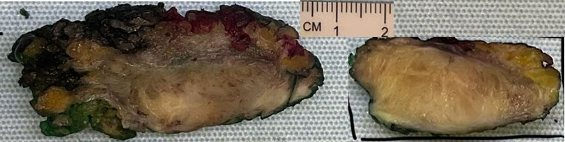 Abdominal Mass