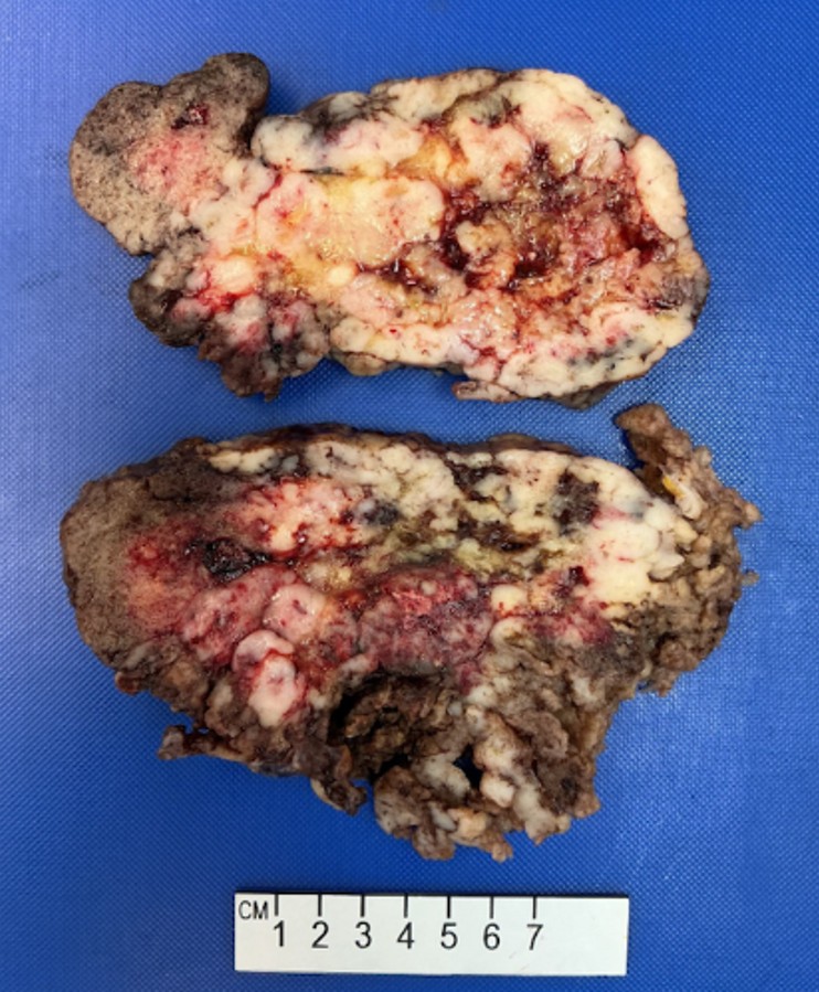gross image of a portion of the resected mass