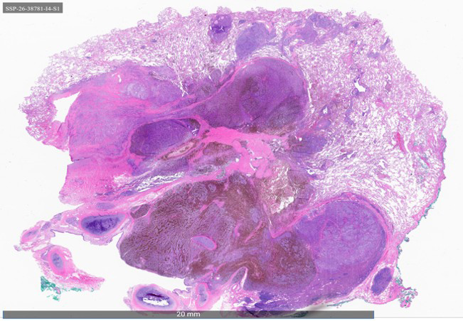 Histologic and immunohistochemical features of the pigmented pulmonary carcinoid