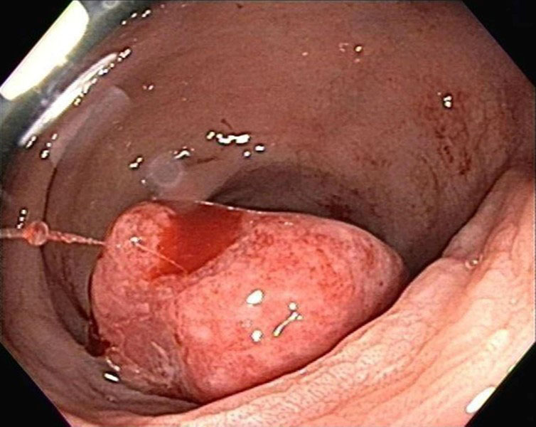 Figure 1: Sigmoid colon polyp identified at time of colonoscopy.
