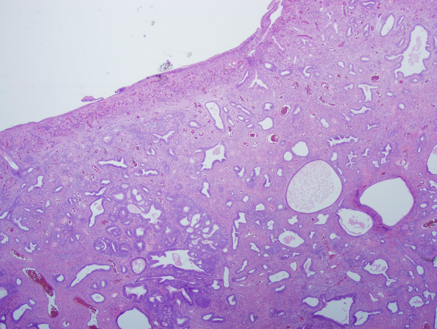 Figure 2 (20x): Surface of the sigmoid polyp showing effacement of normal colonic mucosa by infiltrating glands with cystic dilation and surrounding spindle cell stroma and vascular dilation.