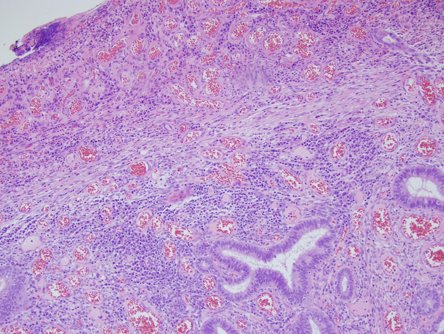 Figure 3 (100x): Sigmoid polyp showing angulated glands with surrounding spindle cell stroma and inflammatory infiltrate