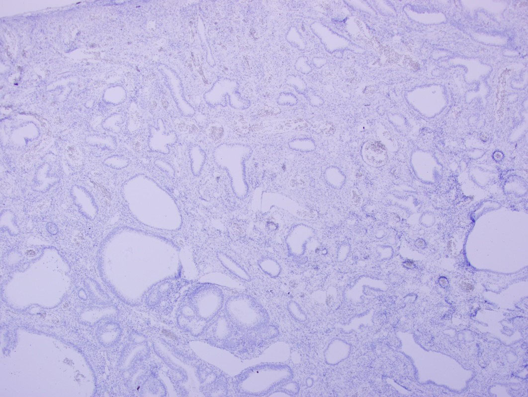 Figure 5: CDX2 IHC stain was negative throughout the polyp.
