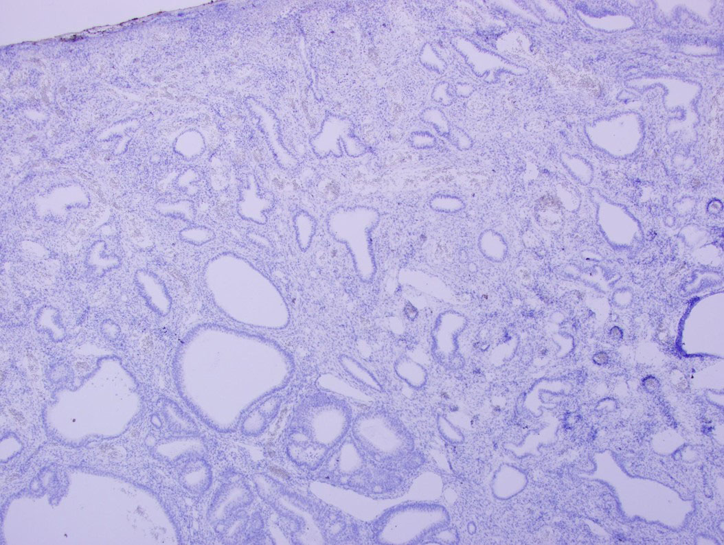 Figure 6: CK20 IHC stain was negative throughout the polyp.