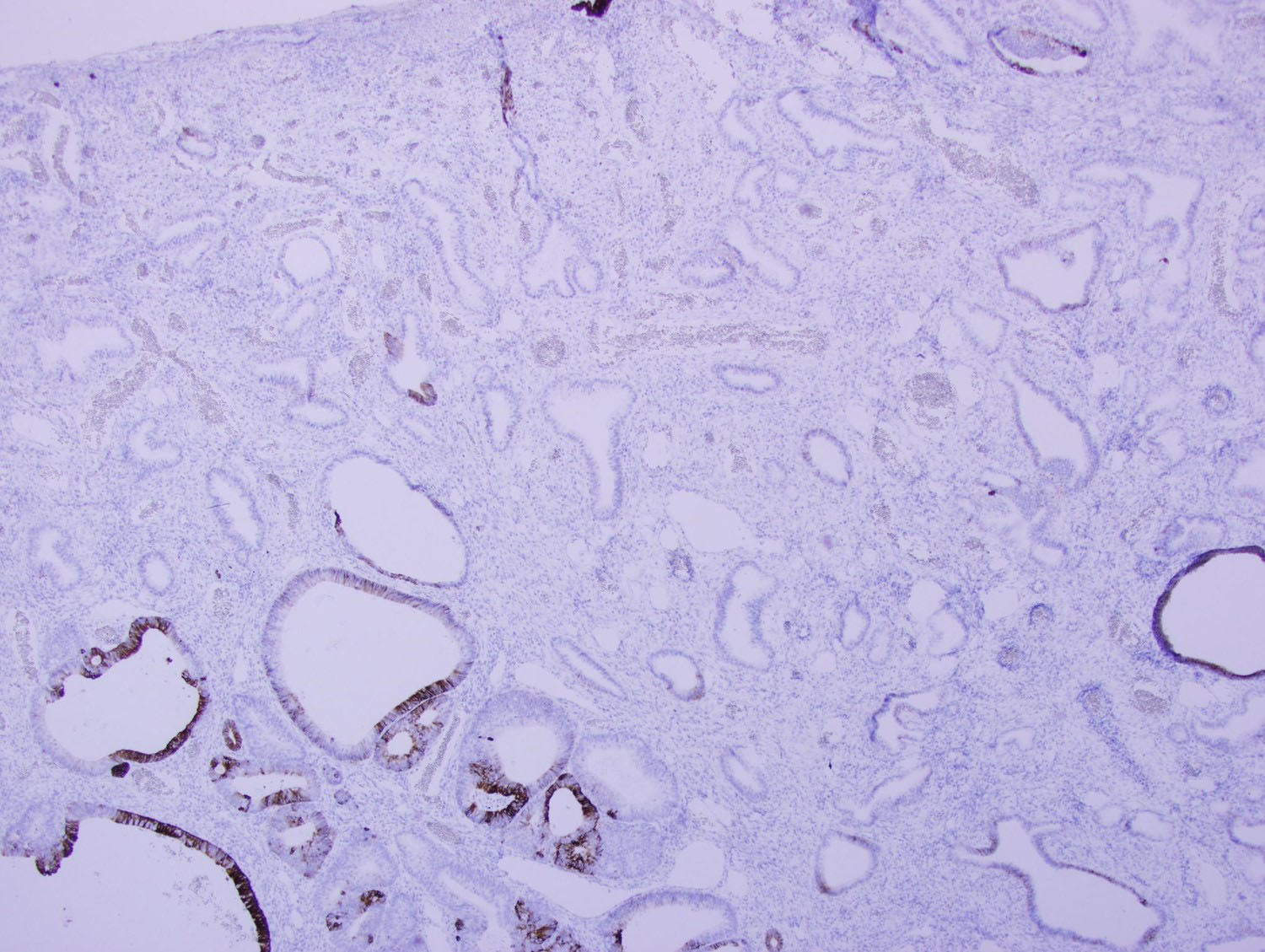 Figure 7: The glandular epithelium was focally strongly positive for CK7 on IHC.