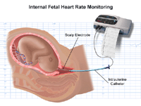 Illustration of internal fetal heart rate monitoring
