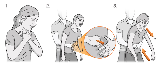 Ilustración de una mujer atragantándose, un hombre tomándola alrededor del estómago desde atrás y utilizando su puño y su mano para realizar la maniobra de rescate.