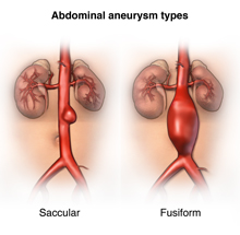 Abdominal Aortic Aneurysm - Health Encyclopedia - University of