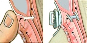  Illustration of a transesophageal puncture
