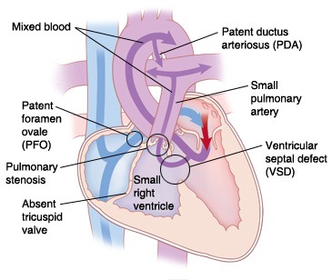 Four-chamber view of heart showing tricuspid atresia. Arrows indicate blood unable to flow from right atrium to right ventricle.