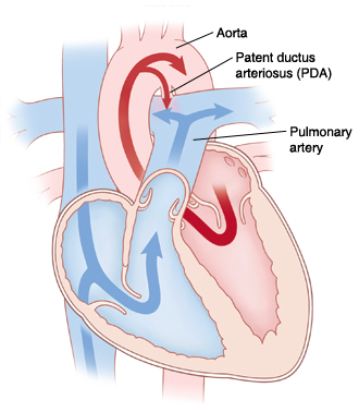 Front view cross section of heart showing patent ductus arteriosus. Arrows indicate blood flowing through patent ductus arteriosus.