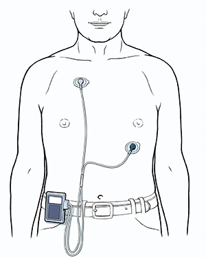 Man's torso showing two ECG leads attached to chest, connected to event monitor clipped to belt.