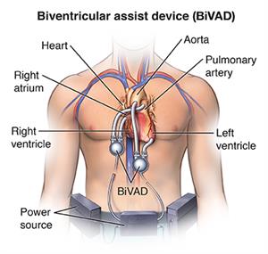 Front view of man's chest showing biventricular assist device attached to heart.