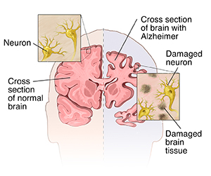 Front view cross section of brain comparing normal on one side and ...