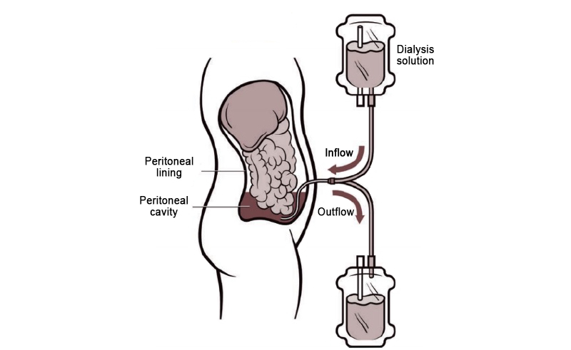 Image shows dialysate entering the belly through the catheter. Once inside, the lining of the belly works like a filter, removing the waste and extra fluid from the blood. When the treatment is complete the dialysate containing the waste and extra fluid drains out of the belly through the same catheter into a designated waste bag.